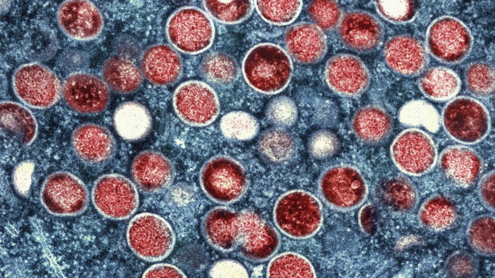 Variole du singe : le processus de transmission du "Clade lb" se précise