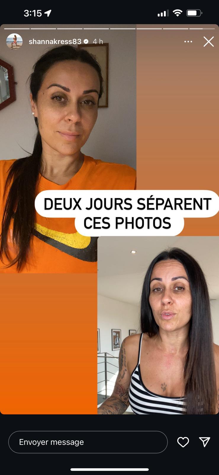 Shanna Kress : la candidate montre l'avant-après de ses injections de botox