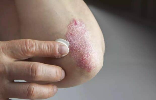 Psoriasis : la liste des aliments à éviter lorsqu’on est atteint de cette maladie chronique