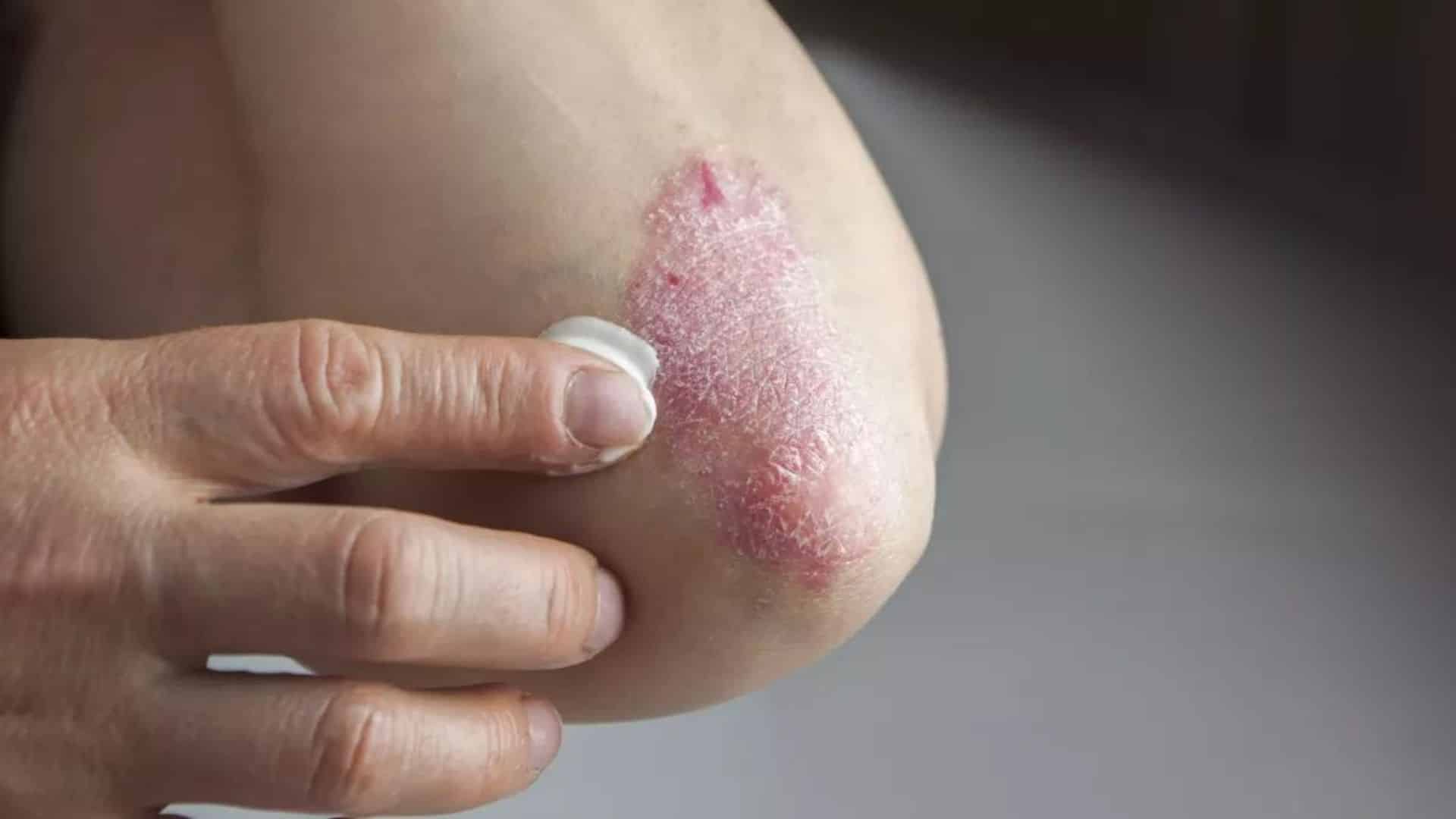 Psoriasis : la liste des aliments à éviter lorsqu’on est atteint de cette maladie chronique