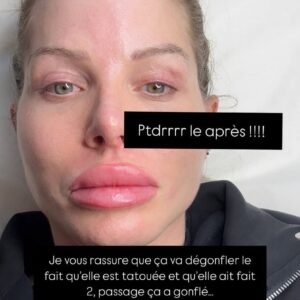 Jessica Thivenin : accusée d'abuser de la chirurgie esthétique, elle montre ses nouvelles lèvres